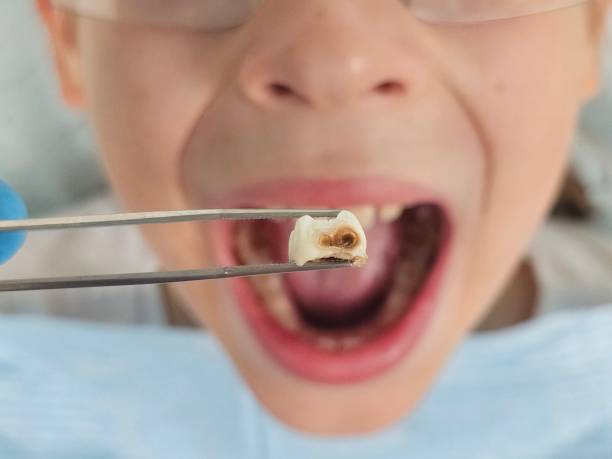 Best Knocked-Out Tooth Emergency  in Sunrise Beach Village, TX